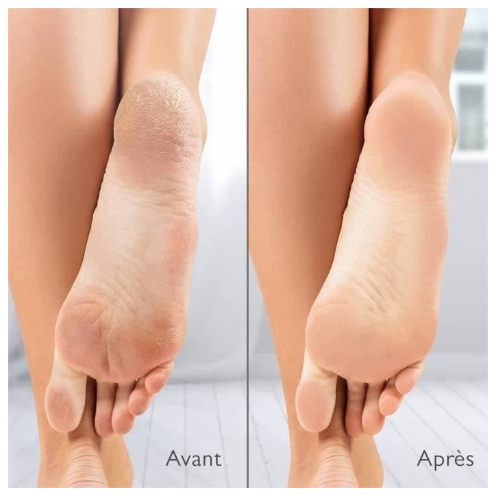 Râpe électrique anti-callosités Silk'n Vacupedi avec aspiration intégrée et 2 râpes incluses Râpe électrique anti-callosités Silk'n Vacupedi avec aspiration intégrée et 2 râpes incluses