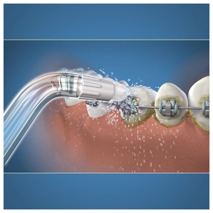 Embout Hydropulseur - WATERPIK - Orthodontique - Élimine la plaque - Spécial appareils dentaires Embout Hydropulseur - WATERPIK - Orthodontique - Élimine la plaque - Spécial appareils dentaires