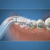 Embout Hydropulseur - WATERPIK - Orthodontique - Élimine la plaque -
